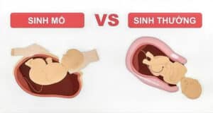 Sinh thường hay sinh mổ